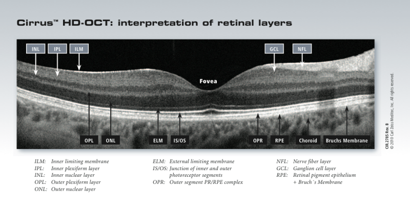 Cirrus OCT Interpretation of Retinal Layers