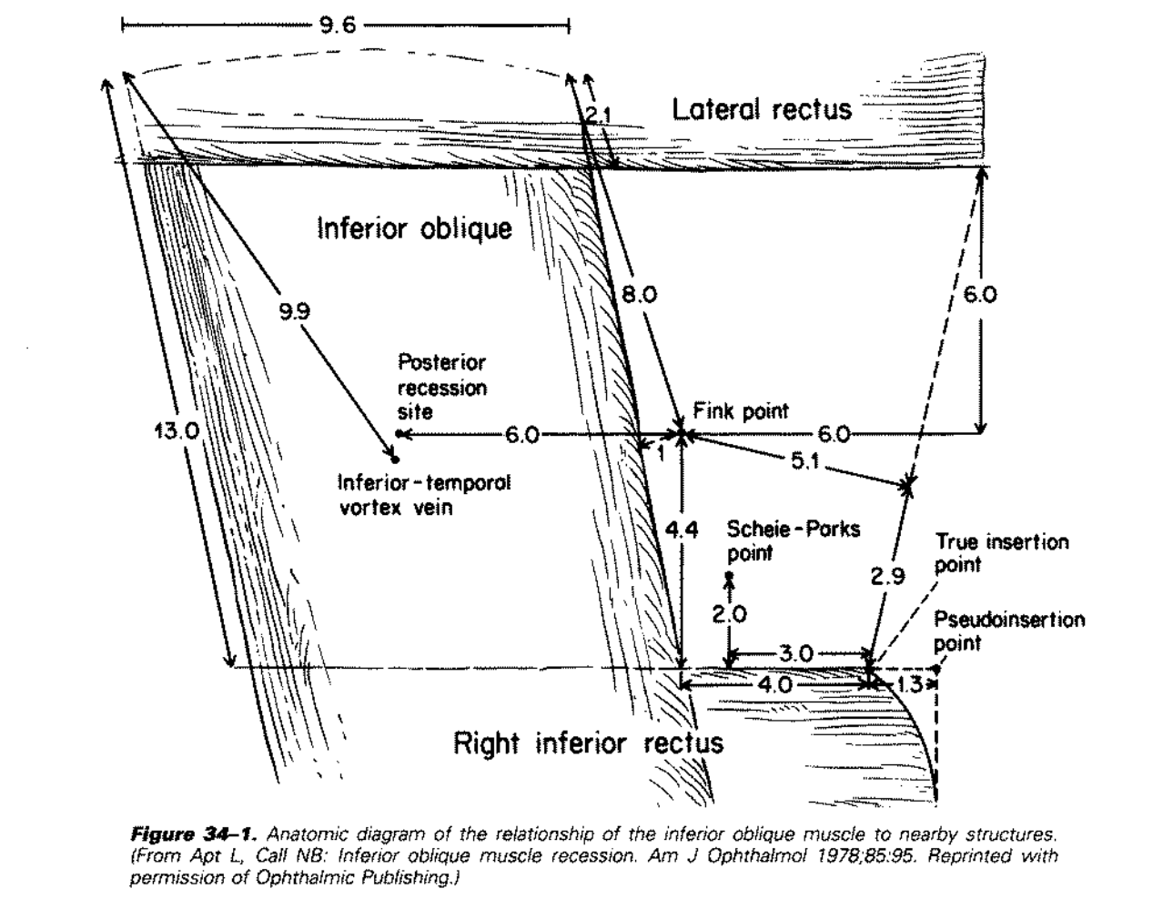 Cerulean Cataract - EyeWiki