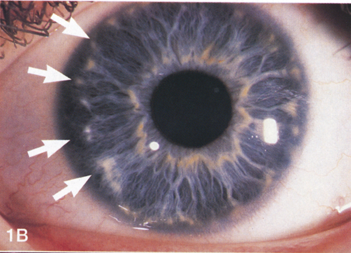 Cerulean Cataract - EyeWiki